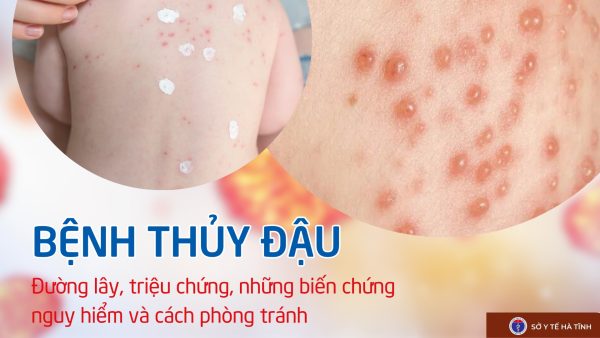 Bệnh thủy đậu những điều cần biết